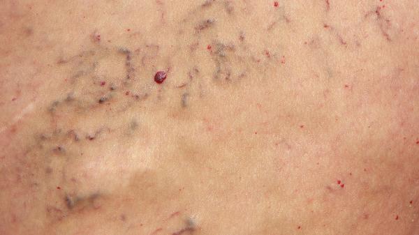 大腿內(nèi)側(cè)疼痛什么原因