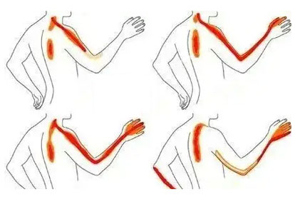 肩周炎一針治療絕技