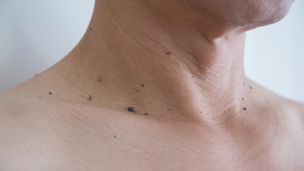 去痣會留疤嗎