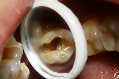 矯正牙齒是否會得蛀牙呢