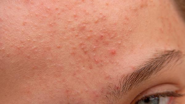 痤疮反复发作怎么根治