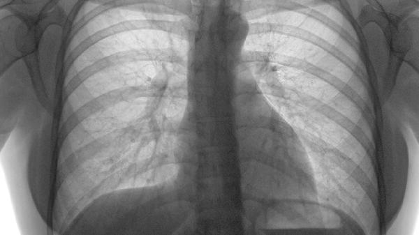 肋骨骨折的护理