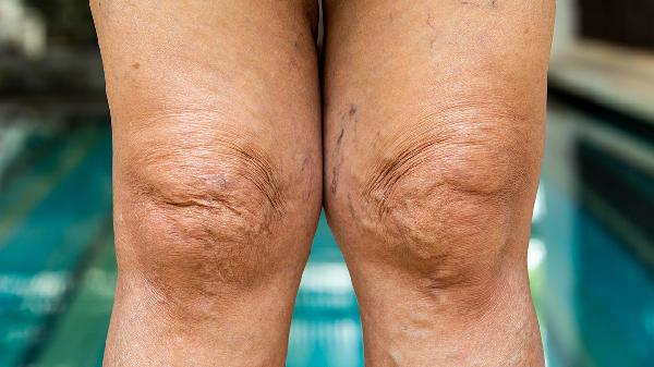 早上開(kāi)始眼皮浮腫的原因是什么