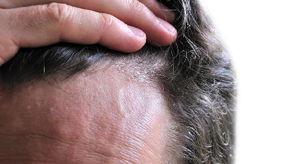 額頭脫發(fā)的原因及治療方法