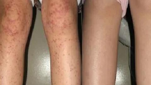 血小板減少性紫癜是什么