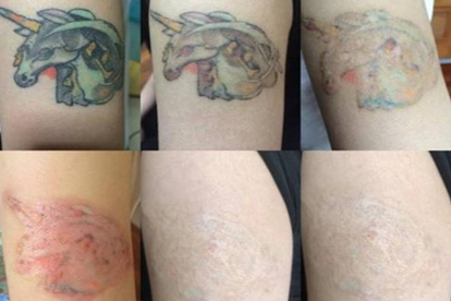 四種方法有助于洗紋身