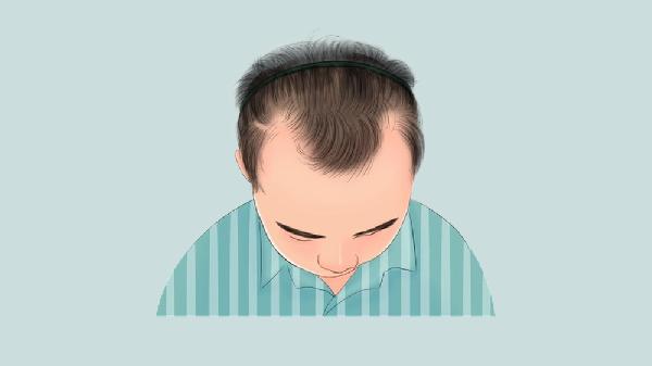 如何拯救日益后退的發(fā)際線(xiàn)