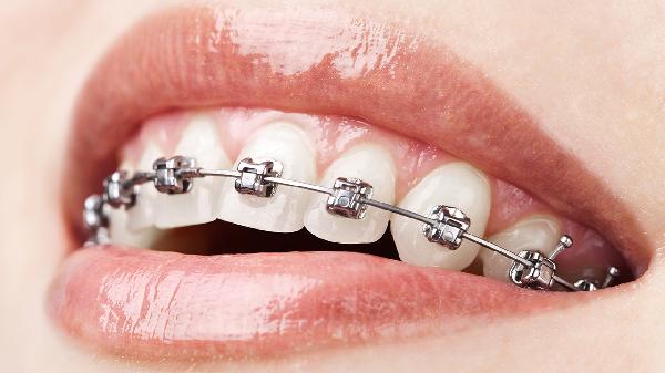 患者牙齒矯正時(shí)一定要戴牙套嗎