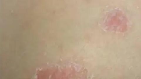 銀屑病的類型是什么