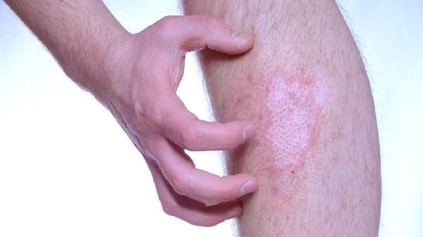 這些人容易感染銀屑病真菌香蕉皮治療銀屑病