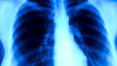 糖尿病患者為什么容易得肺結(jié)核