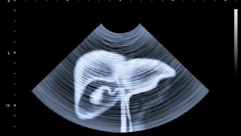 如何延長丙肝患者的壽命