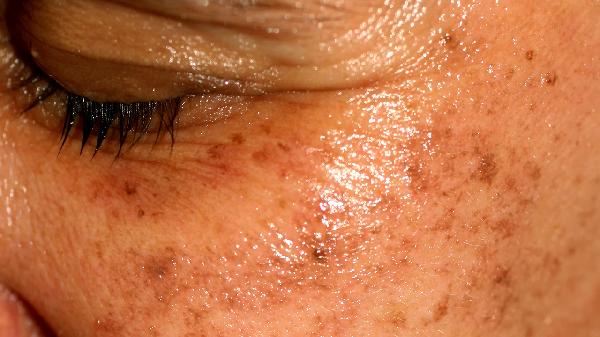 老年斑的形成原因是如何預(yù)防和治療老年斑