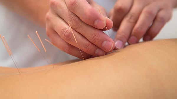 中醫(yī)針灸治療痤瘡的方法