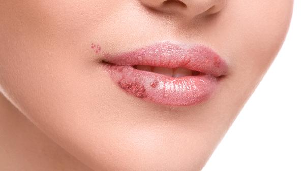 陰部皰疹如何進(jìn)行治療