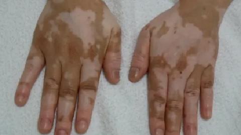 治療白癜風(fēng)不僅僅是通常的治療