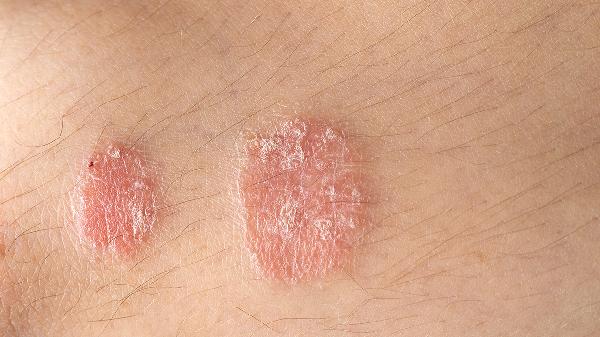 紅皮型銀屑病的臨床癥狀
