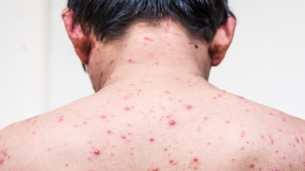 膿包瘡不是痱子中醫(yī)這樣烹飪可以治療膿皰瘡