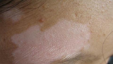 這些癥狀表明白癜風(fēng)的病情好轉(zhuǎn)