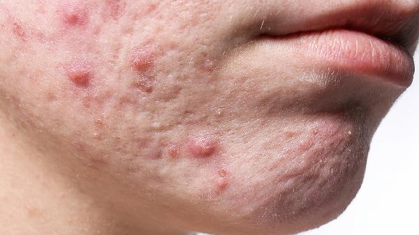 臉上長(zhǎng)痘痘的原因是什么