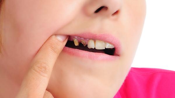 兒童蛀牙如何治療