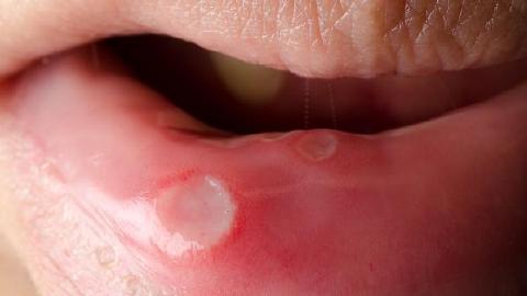 口腔潰瘍用什么藥最好