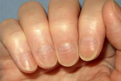 手指出現(xiàn)這些情況，是心臟在向你發(fā)出“求救”……