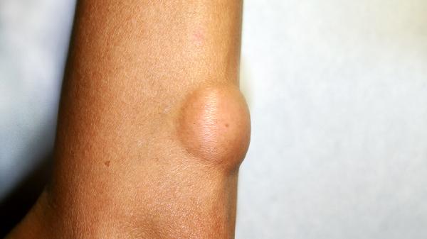 神經(jīng)纖維瘤的保健護(hù)理