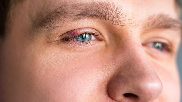 冬天眼睛流淚怎么辦