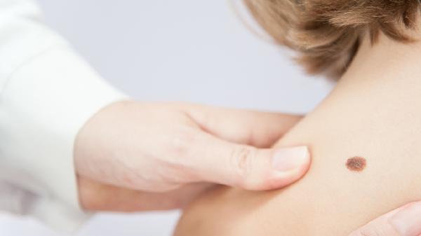 激光去胎記讓你有完美的臉