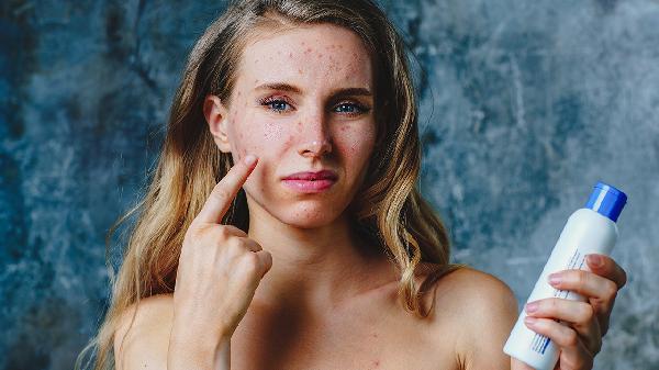 激光祛痘術(shù)后的三個(gè)維護(hù)事項(xiàng)