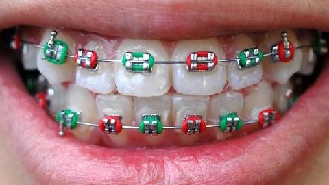 牙齿矫正患者不应该吃高纤维的食物