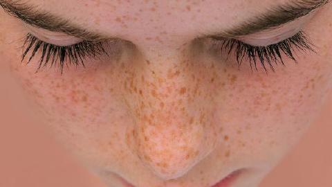 光子去除斑点要多少钱