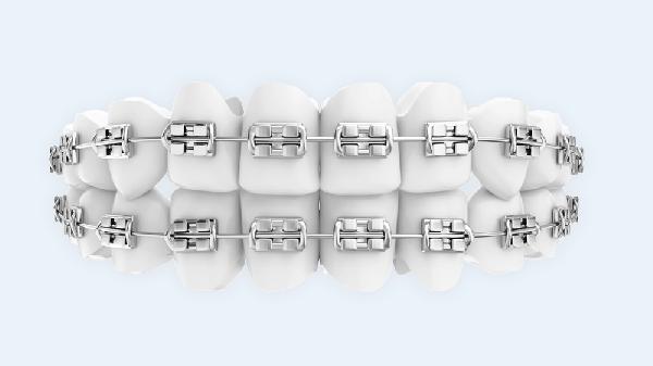 患者做牙齿矫正需要多长时间