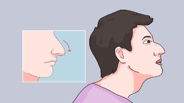 鹰钩鼻矫正手术的两个要点