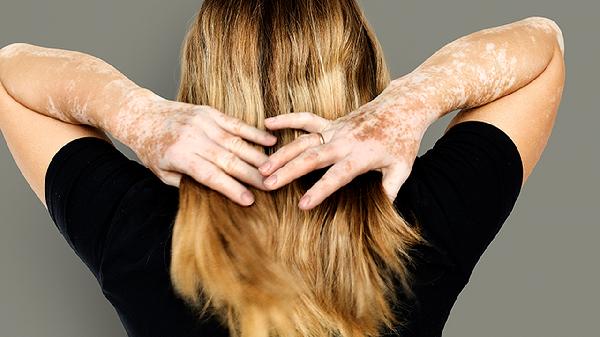 白癜風(fēng)308照射后要多長(cháng)時(shí)間