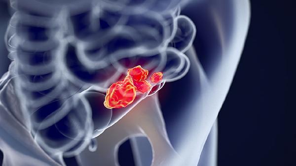胃鏡做了半年會(huì )癌變嗎胃半年癌變的原因是什么