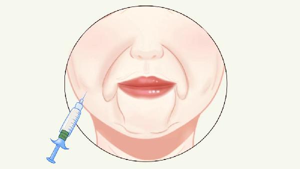 透明質酸除皺的價格是多少