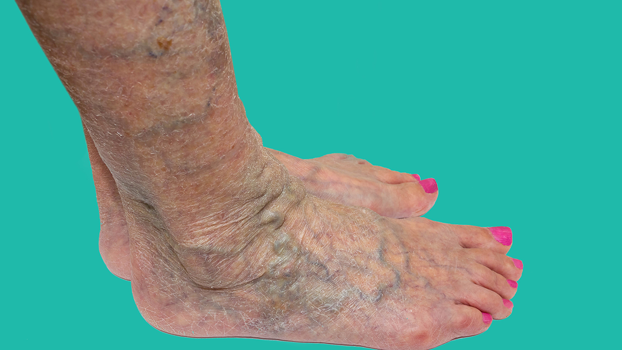 妊娠糖尿病40周需要催产么