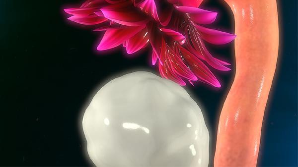 主动脉夹层动脉瘤