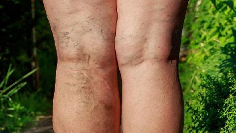 髋关节炎的锻炼方法