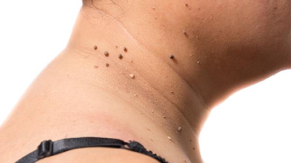 怎么判断是不是黑色素痣