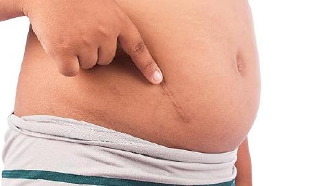 疤痕修复多少钱