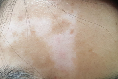 治療白斑用什么藥效果最好