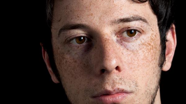 臉上長(zhǎng)黑斑怎么辦