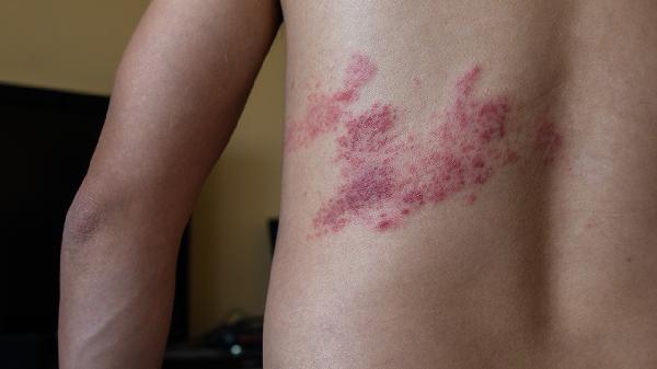 牛皮皮癣用什么药膏治疗效果好