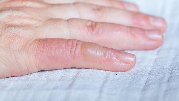 被熱水燙出水泡怎么辦