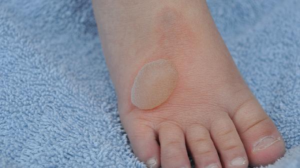 水泡足癬用什么藥有特效