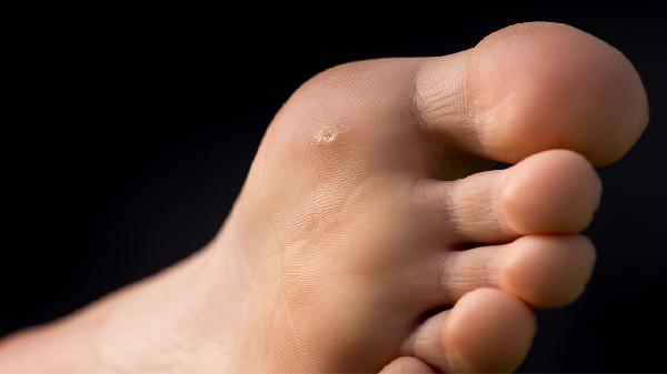 扁平足是啥樣子