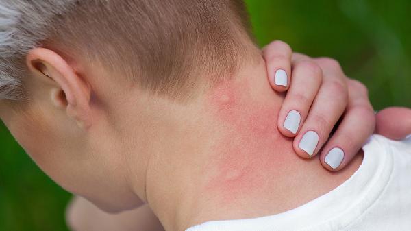 身上长痱子是怎么回事